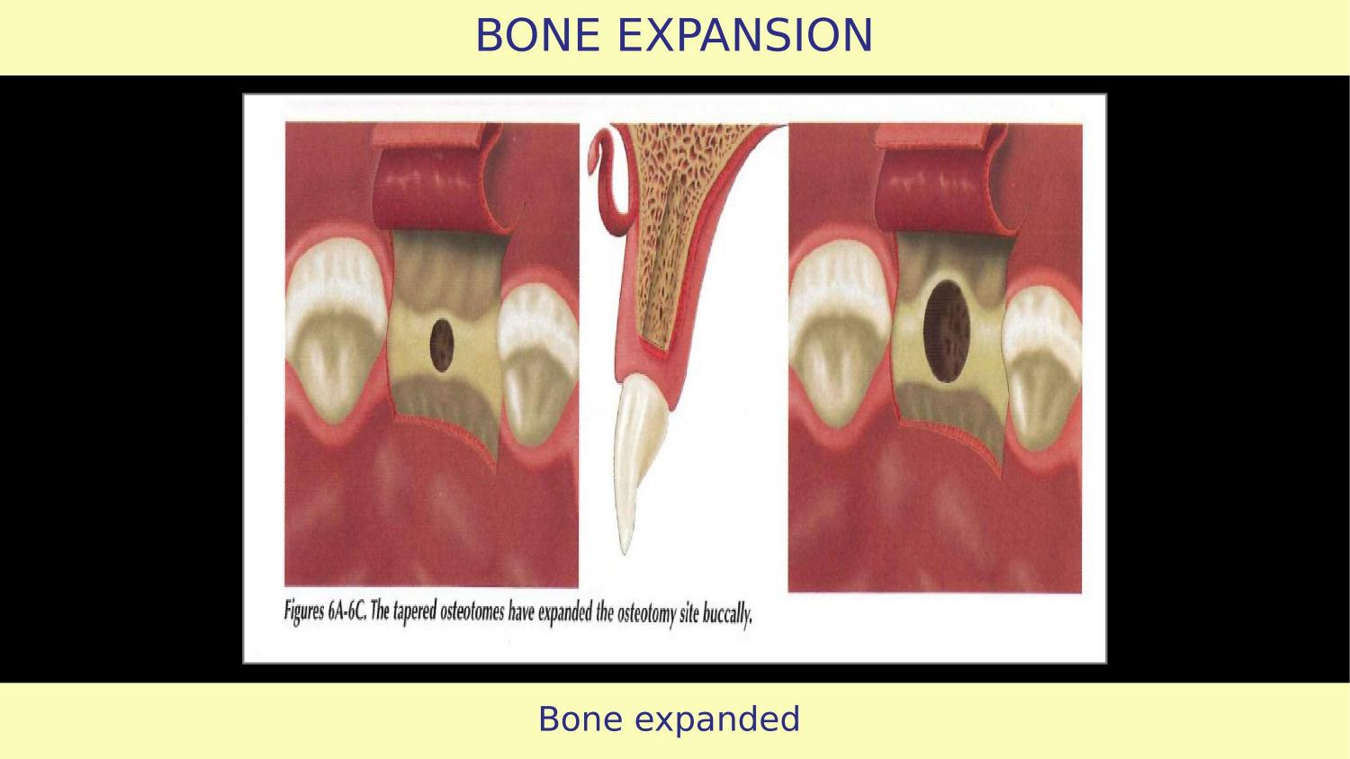 How Osteotomes Should Not Be Used — Part 1 — Slide 8
